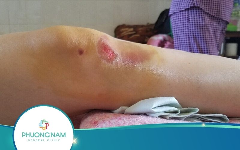 Vết Thương Lên Da Non Kiêng Ăn Gì? Thông Tin Hữu Ích