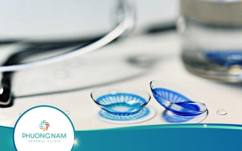 [Giải Đáp] Kính Áp Tròng Chữa Cận Thị Giá Bao Nhiêu?