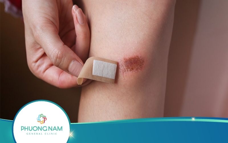 Vết Thương Té Xe Bao Lâu Thì Lành? Thông Tin Hay – Xem Ngay!