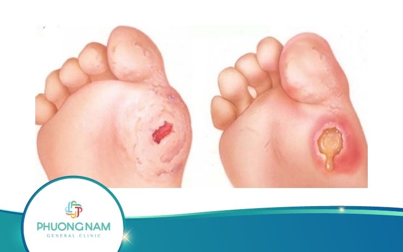 4 Bước Điều Trị Vết Thương Lở Loét Bạn Nhất Định Phải Biết