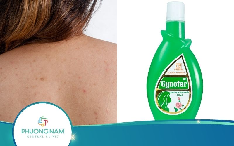 Gynofar Trị Mụn Lưng Có Hiệu Quả Không? Liệu Có Nên Áp Dụng?
