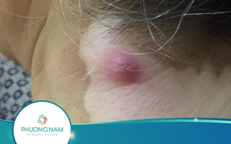 Cách Trị Mụn Sau Gáy Hiệu Quả – Bạn Nhất Định Phải Biết