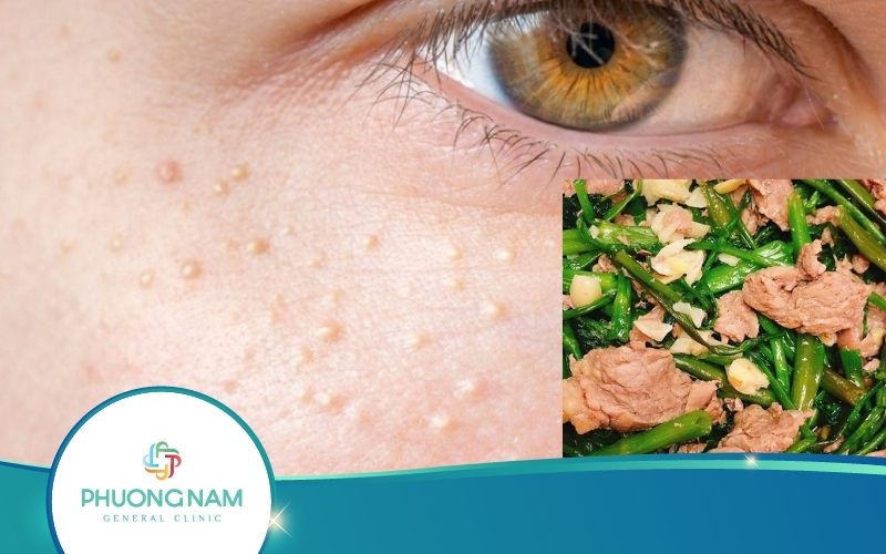 Bắn Mụn Thịt Kiêng Ăn Gì? Cần Lưu Ý Gì Để Nâng Cao Hiệu Quả?