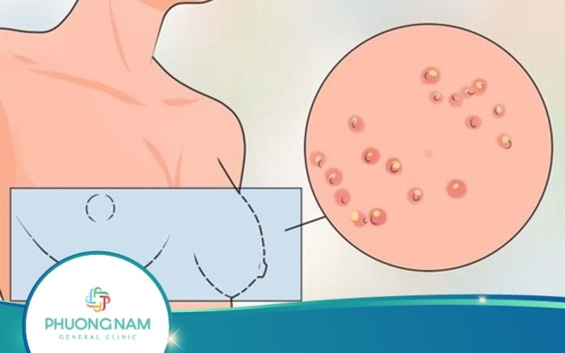 Nhũ Hoa Nổi Mụn Thịt – Nguyên Nhân Và Cách Điều Trị