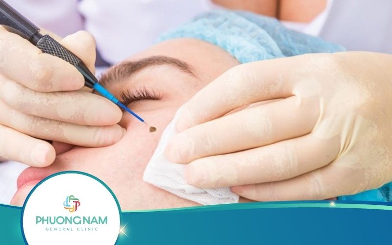 Tẩy Nốt Ruồi Bao Lâu Thì Lành? Có Để Lại Sẹo Không?