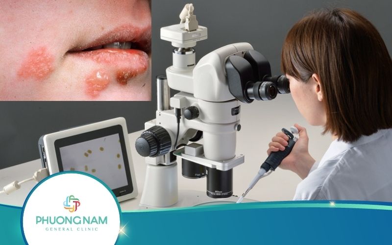 Xét Nghiệm Bệnh Lậu – Những Thông Tin Quan Trọng Cần Nắm