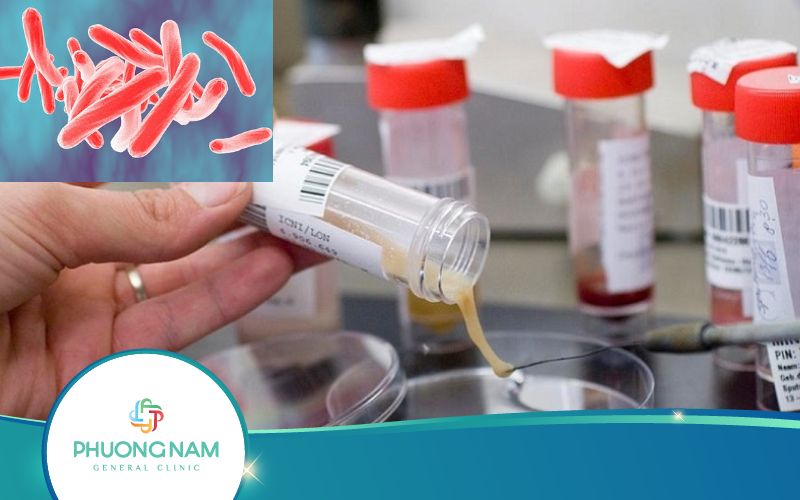 Xét Nghiệm Lao Phổi – Những Thông Tin Quan Trọng Cần Biết