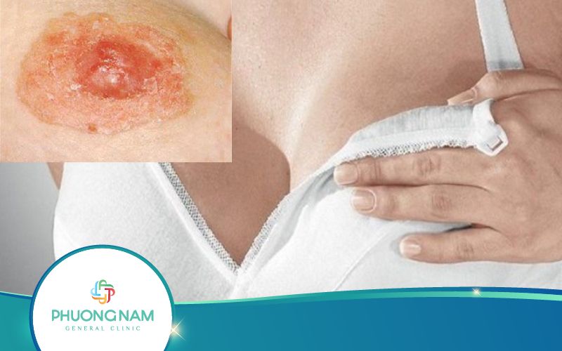 Nhũ Hoa Bị Đóng Vảy – Nguyên Nhân, Cách Khắc Phục