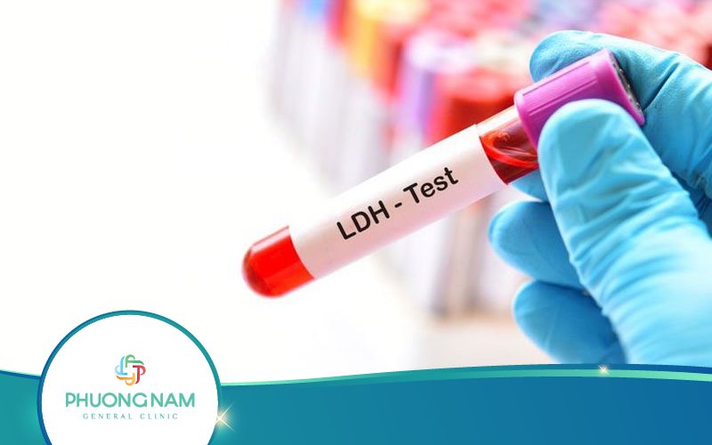 Xét Nghiệm LDH Là Gì? Khi Nào Cần Thực Hiện?