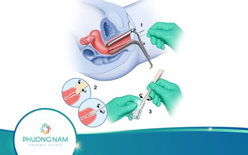 Xét Nghiệm Tế Bào Học Bằng Phương Pháp Liqui Prep Là Gì?