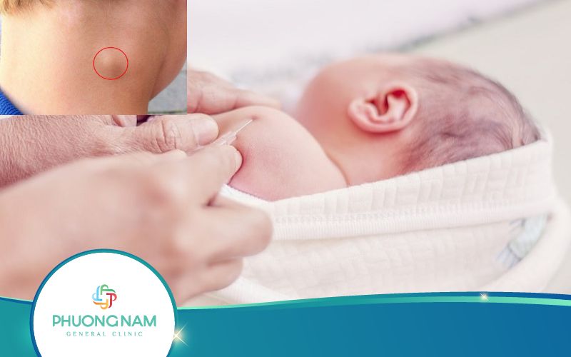 Bị Nổi Hạch Ở Cổ Có Phải Do Tiêm Phòng Lao Hay Không?