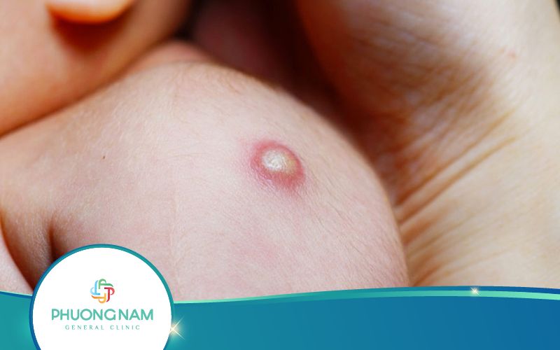 Chăm Sóc Vết Tiêm Phòng Lao Như Thế Nào Khi Bị Mưng Mủ?