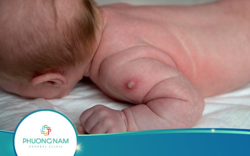 Nặn Mủ Vết Tiêm Lao Có Sao Không? – Bác Sĩ Trả Lời