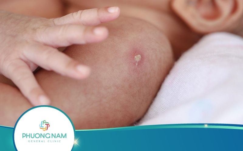 Những Phản Ứng Sau Tiêm Phòng Lao Phụ Huynh Nên Biết