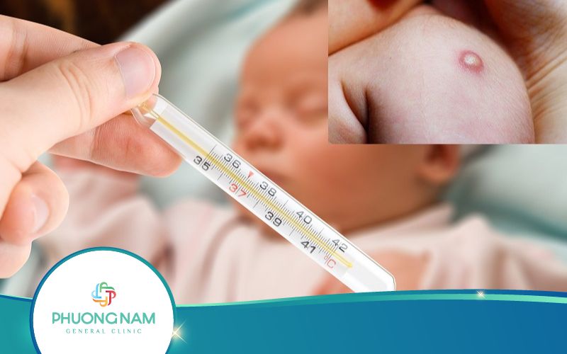 Trẻ Sốt Nhẹ, Mưng Mủ Khi Tiêm Ngừa Lao Có Đáng Lo Không? – Bác Sĩ Tư Vấn
