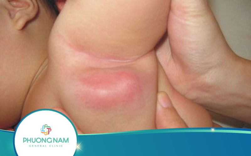 Trẻ Tiêm Vacxin Lao Bị Nổi Hạch Sưng Đỏ Ở Nách Có Phải Rạch Tháo Mủ Không?