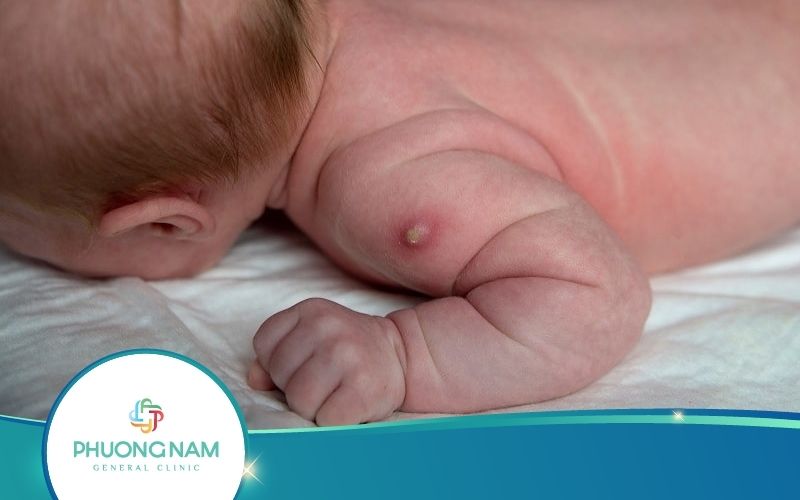 Vết Tiêm Lao Mưng Mủ Có Đáng Lo Không? Cách Chăm Sóc Vết Tiêm