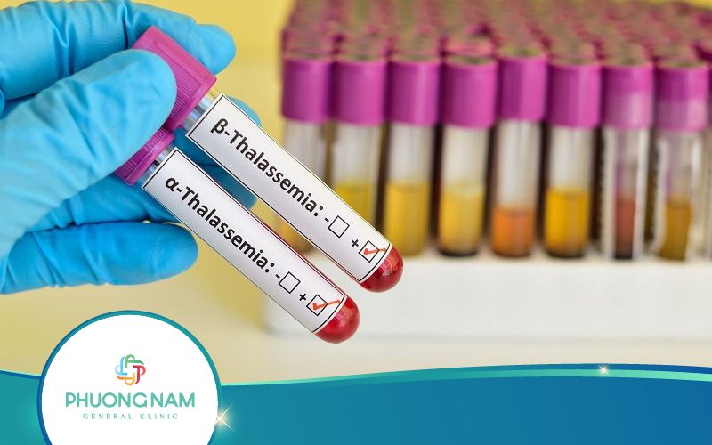 Xét Nghiệm Tan Máu Bẩm Sinh Có Vai Trò Gì?