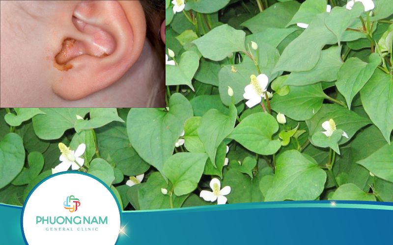 Top 3 Cách Chữa Viêm Tai Giữa Bằng Rau Diếp Cá Hiệu Quả Nhất