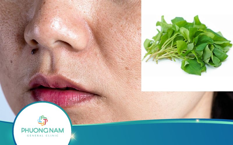 Top 8 Cách Trị Nám Bằng Rau Diếp Cá Hiệu Quả Nhất!