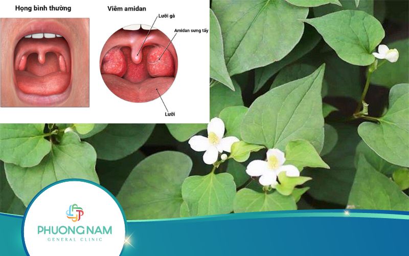 Top 7 Cách Chữa Viêm Amidan Bằng Rau Diếp Cá