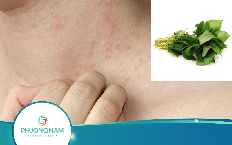 Dùng Rau Diếp Cá Trị Bệnh Sởi Như Thế Nào?
