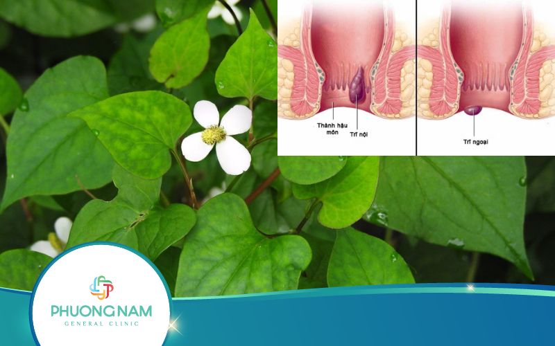 Dùng Rau Diếp Cá Trị Bệnh Trĩ Như Thế Nào Hiệu Quả?