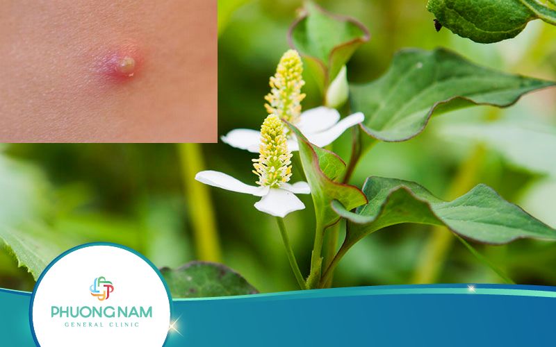 Dùng Rau Diếp Cá Trị Mụn Nhọt Như Thế Nào Hiệu Quả?