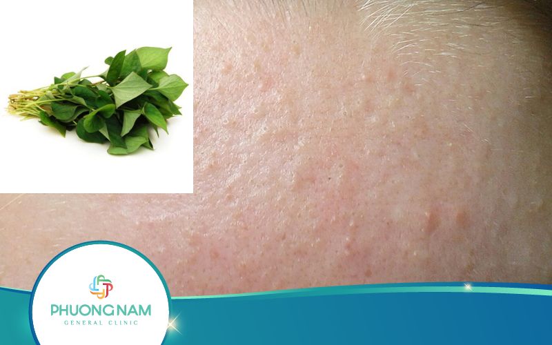 Trị Mụn Ẩn Bằng Rau Diếp Cá Như Thế Nào Đúng Cách?