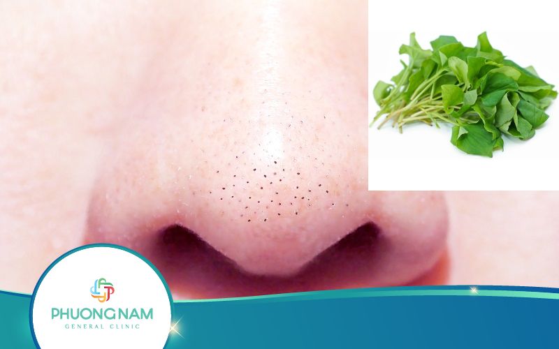 Trị Mụn Đầu Đen Bằng Rau Diếp Cá Như Thế Nào Hiệu Quả?