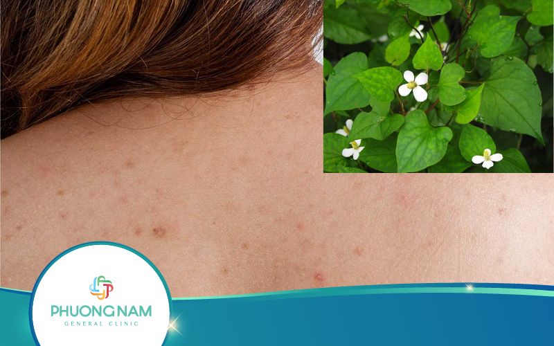 Trị Mụn Lưng Bằng Rau Diếp Cá Như Thế Nào Đúng Cách?