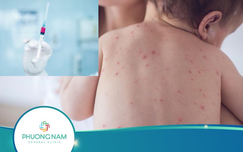 Bị Thủy Đậu Rồi Có Cần Tiêm Phòng Nữa Không? Vì Sao?