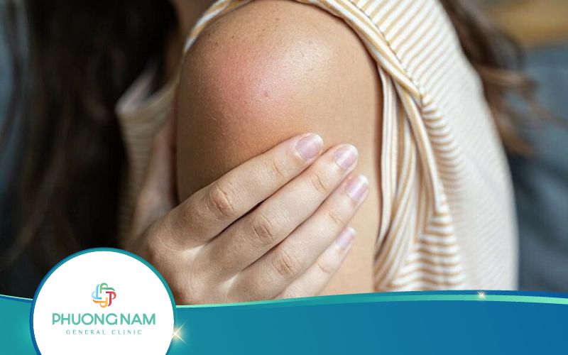 Mẹ Bầu Tiêm Uốn Ván Bị Nhức Tay Đau Tay Phải Làm Sao?