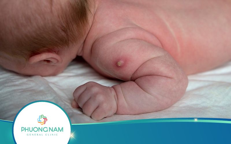 Tiêm Phòng Lao Không Có Sẹo Hiệu Quả Không?