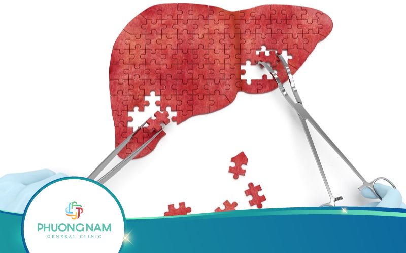 Bị Viêm Gan B Sống Được Bao Lâu? Chuyên Gia Giải Đáp!