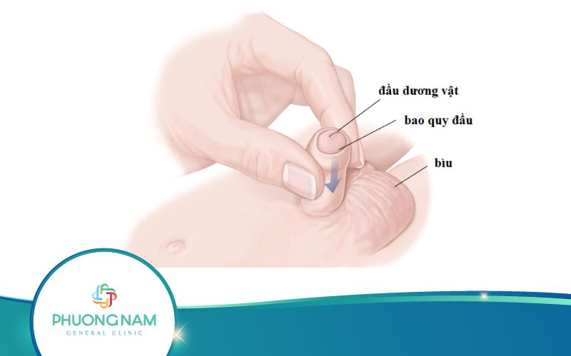 Có Cách Cắt Bao Quy Đầu Tại Nhà Nào Hiệu Quả Không?