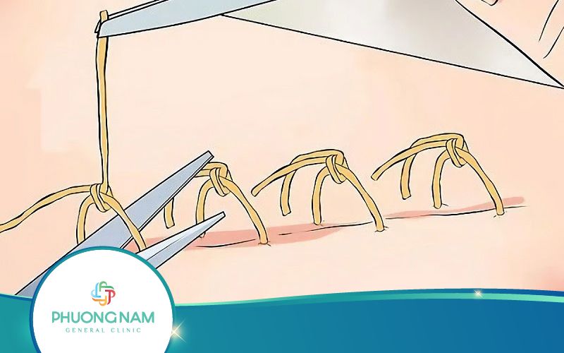 Cách Cắt Chỉ Bao Quy Đầu Tại Nhà Như Thế Nào?