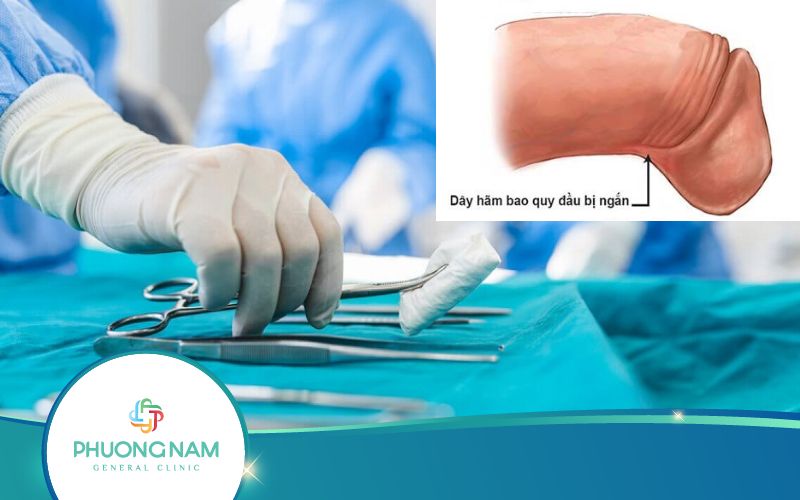 Cắt Dây Hãm Bao Quy Đầu Là Gì? Thực Hiện Thế Nào?