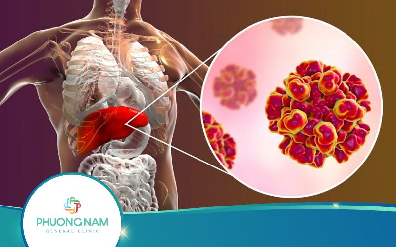 Phân Biệt Viêm Gan B Cấp Tính Và Mãn Tính Như Thế Nào?
