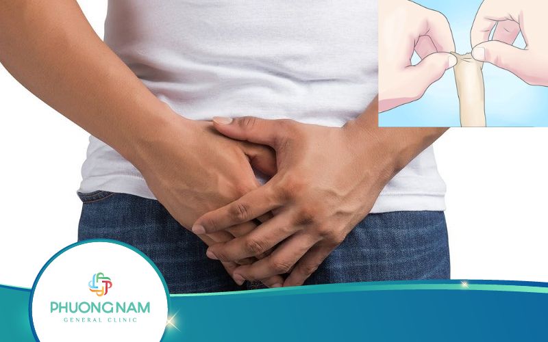 Cách Chữa Bán Hẹp Bao Quy Đầu Tại Nhà Hiệu Quả, An Toàn