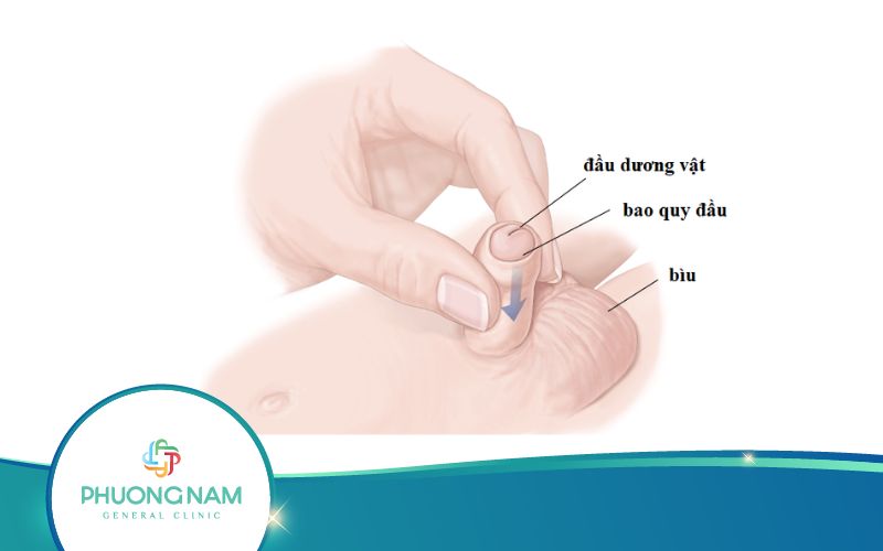 Cách Chữa Hẹp Bao Quy Đầu Tại Nhà Hiệu Quả, An Toàn