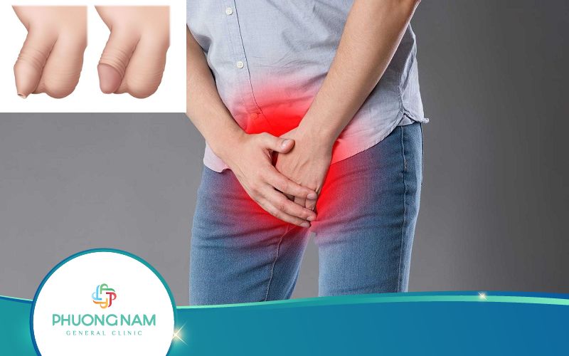 Cách Khắc Phục Dài Bao Quy Đầu Tại Nhà Như Thế Nào?