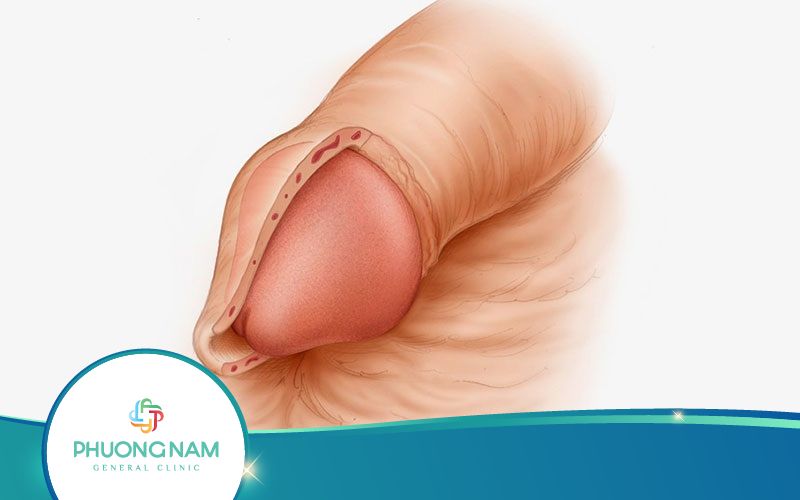 Có Nên Cắt Bao Quy Đầu Trước Khi Lấy Vợ Không?