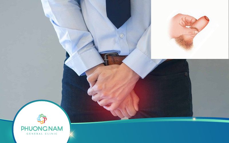 Dài Bao Quy Đầu Giả Là Gì? Có Nguy Hiểm Hay Không?