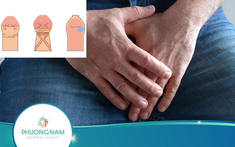 Dài Hẹp Bao Quy Đầu – Nguyên Nhân, Tác Hại, Cách Chữa Trị