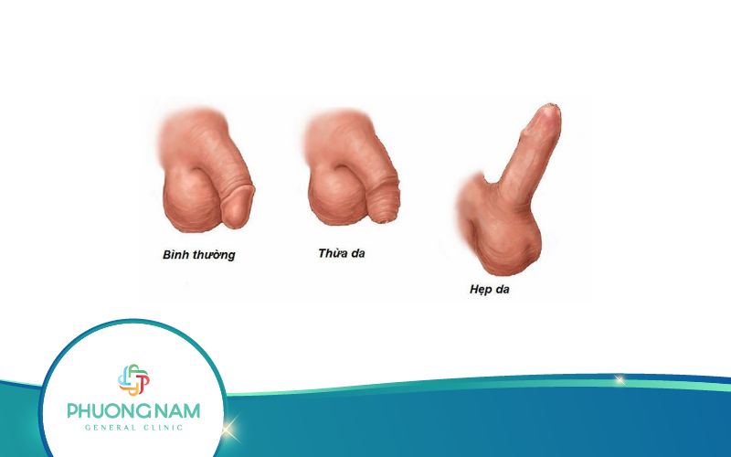Hình Ảnh Sau Khi Lột Bao Quy Đầu Như Thế Nào?