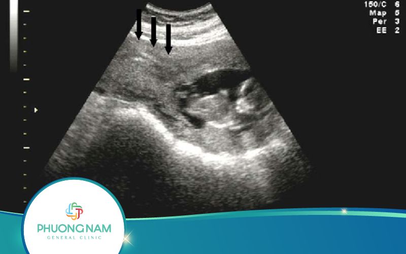 Hình Ảnh Siêu Âm Thai Ngoài Tử Cung Như Thế Nào?