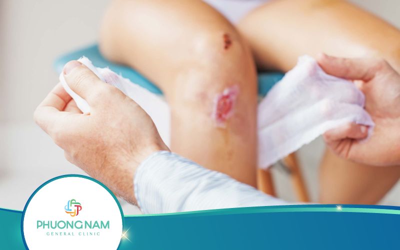 Giải Đáp: Người Nhiễm HIV Vết Thương Có Lành Không?