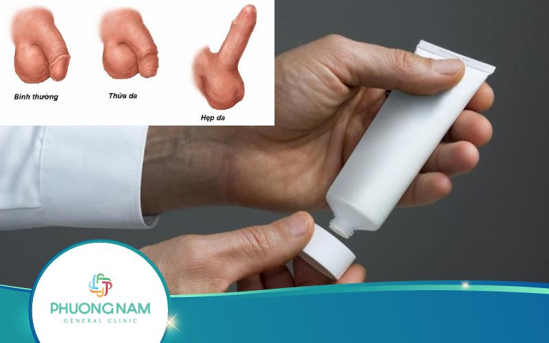 Thuốc Lột Bao Quy Đầu Và Những Điều Cần Biết