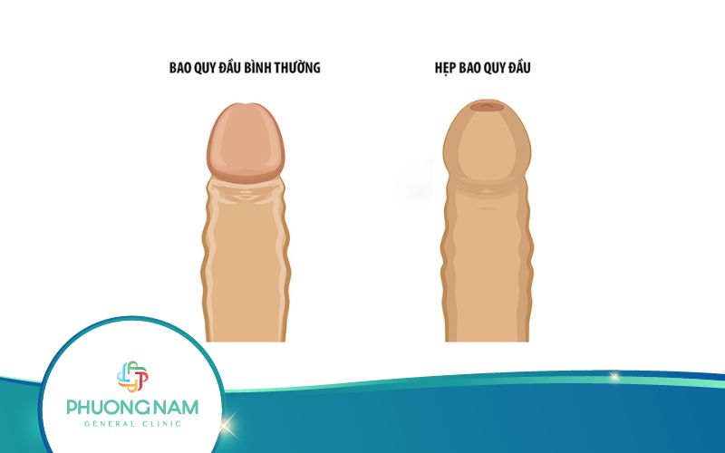 Trẻ Bị Hẹp Bao Quy Đầu Có Ảnh Hưởng Gì Không?